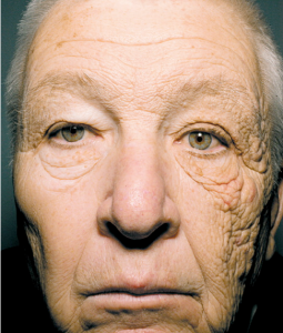 Unilateral Dermatoheliosis (one-sided sun damaged skin)