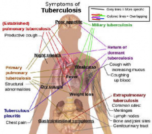 symptomsTB